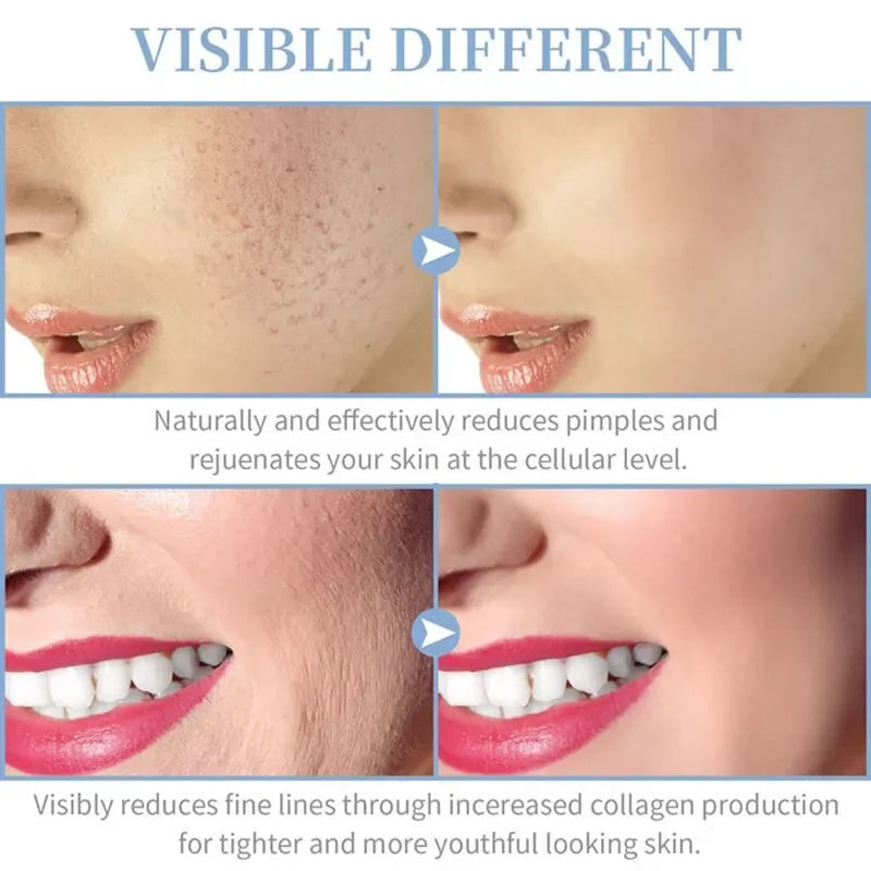 Portable High Frequency Skin Therapy Wand Kit